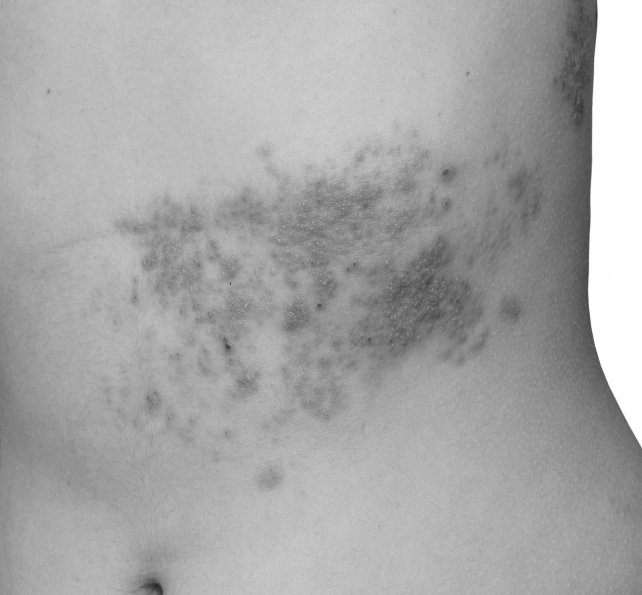 Herpes zoster (Gürtelrose)