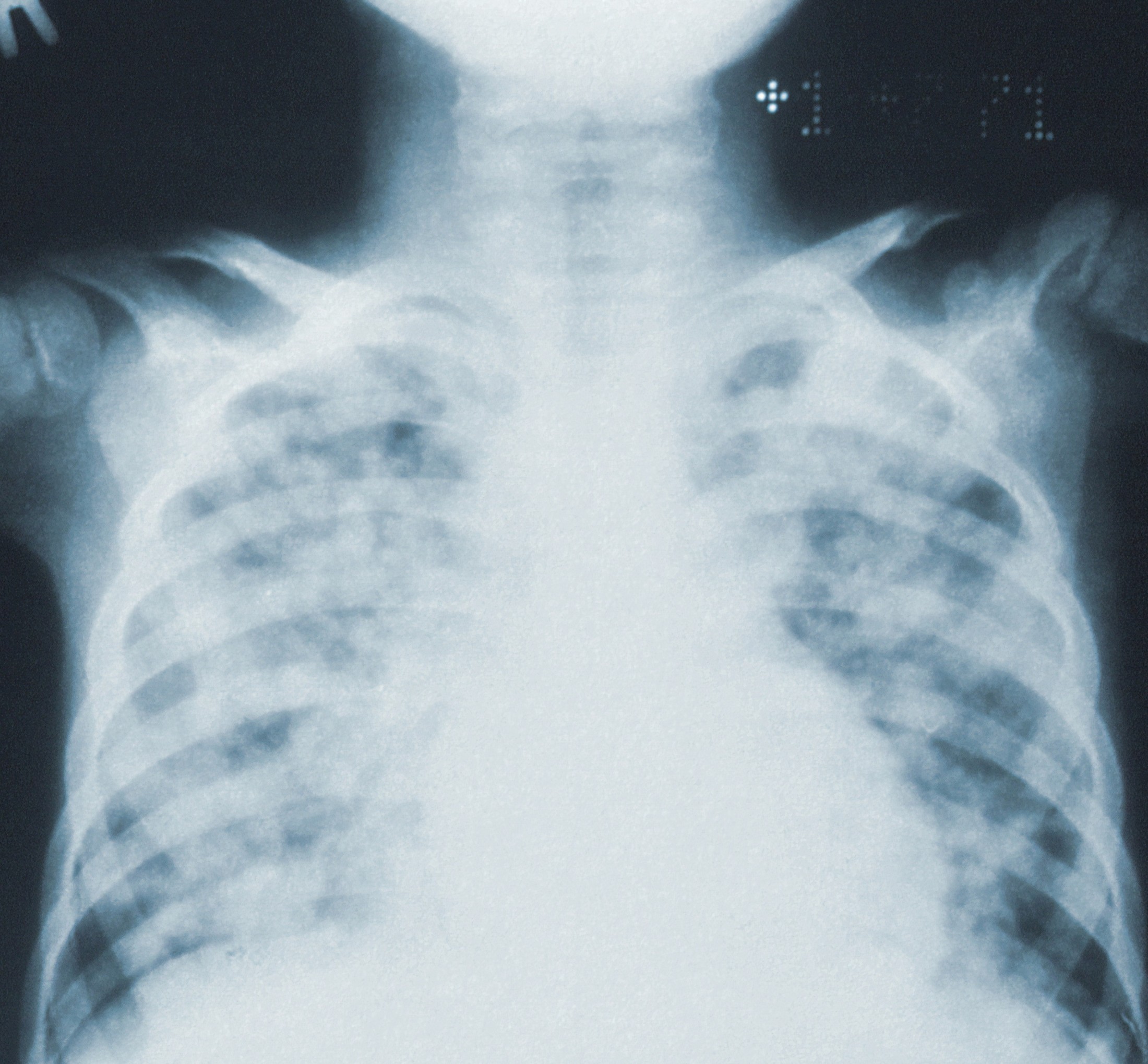 Pneumokokken (bakt. Lungenentzündung)